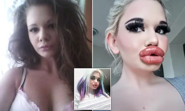 25-Year-Old Bulgarian Woman Has More Than 27 Procedures To Have The Biggest Lips In The World